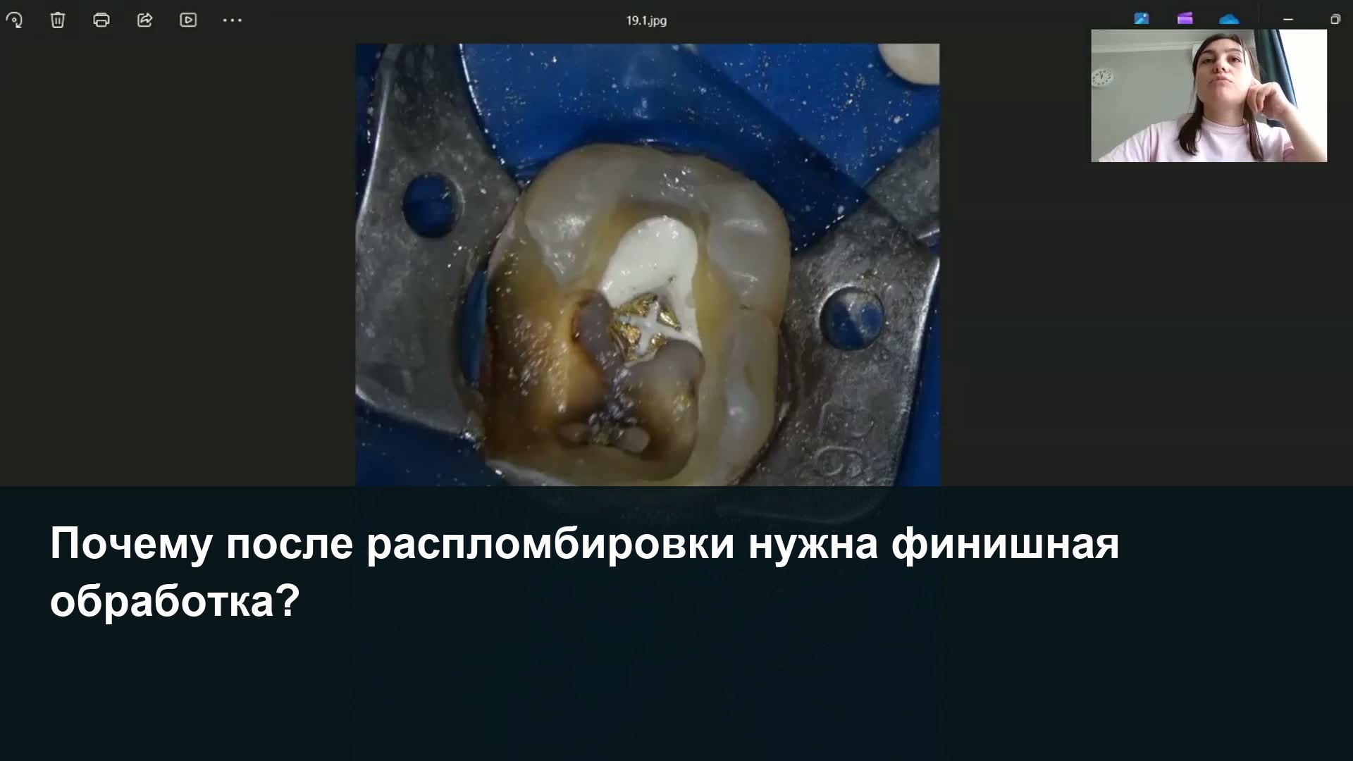 Кадр видеоразбора ENDOkey при перелечивании